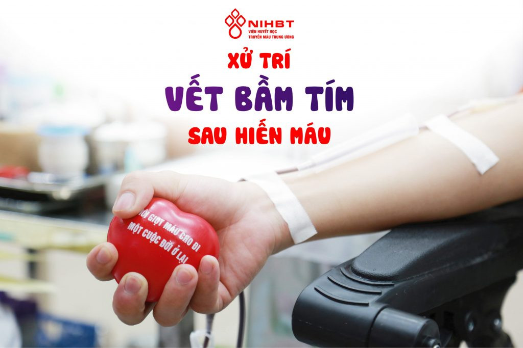 Hình ảnh vết bầm tím có thể xuất hiện sau tình trạng vỡ ven khi lấy máu