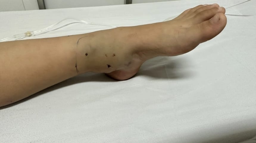 Bị cắn vào chân ẩn ý điều gì?