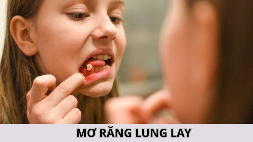 Giải Mã Giấc Mơ Răng Lung Lay Chuẩn Và Đầy Đủ Nhất