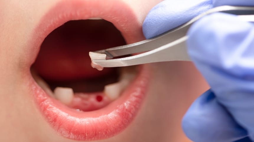 Ngủ mơ nhổ răng có đáng sợ hay không?