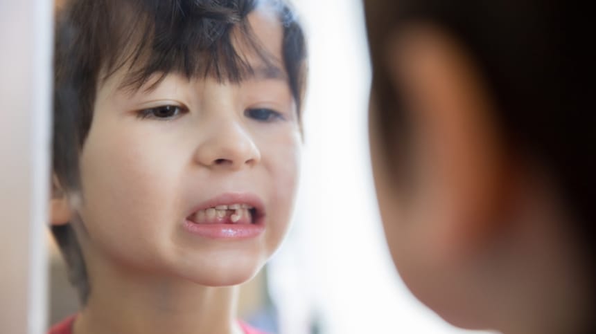 Những lưu ý cần tránh sau khi mơ răng lung lay