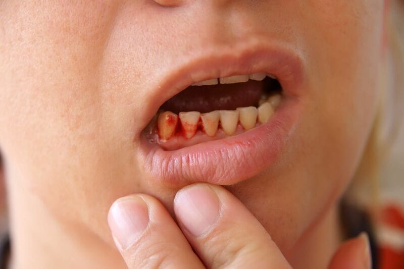 Mơ chảy máu răng: Dự báo điềm lành hay dữ, đánh số nào đại phát?